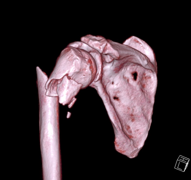 Proximal humerus off ended