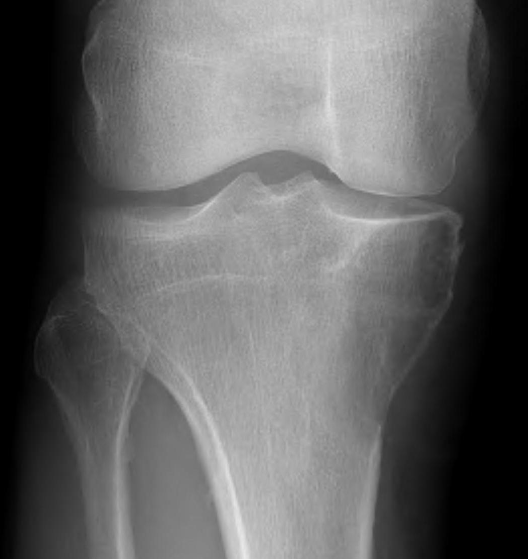 Chondroblastoma xray