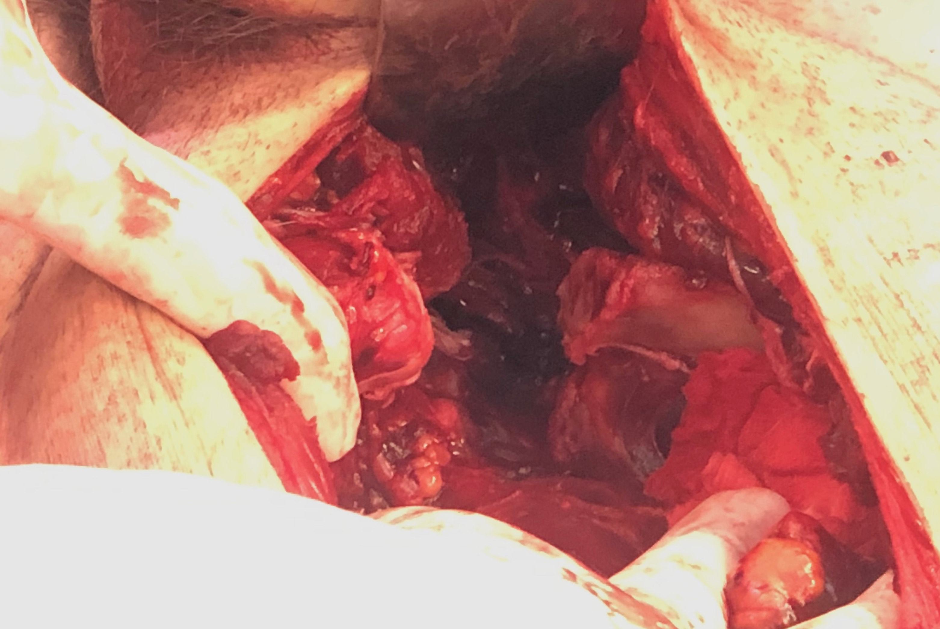 Retroperitoneal packing 2