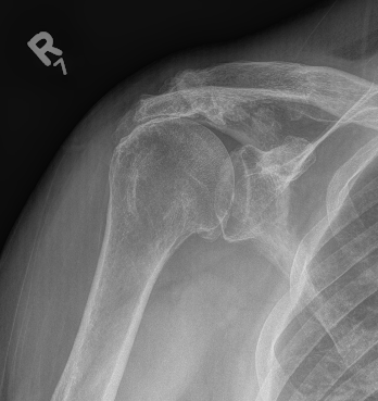 Rotator cuff arthropathy