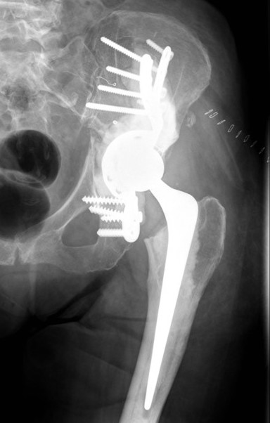 Acetab met saddle 1