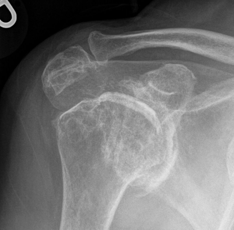 Rheumatoid Shoulder 1