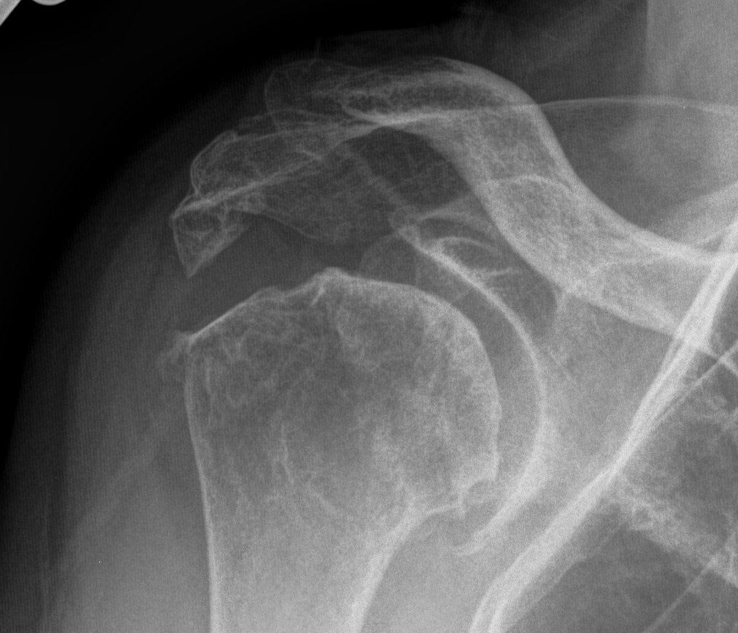 Rheumatoid Shoulder Xray