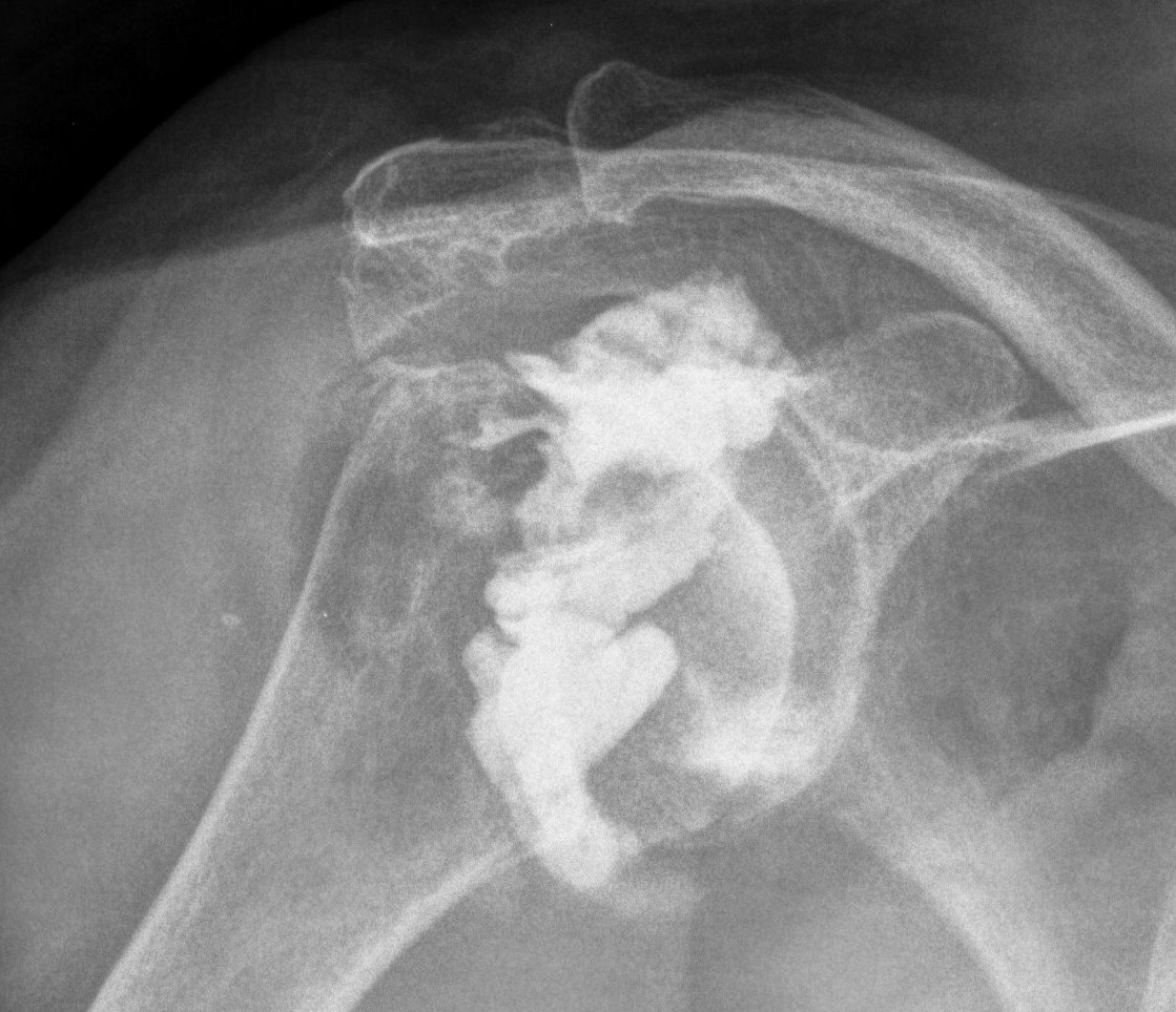 Rheumatoid Shoulder Arthrogram