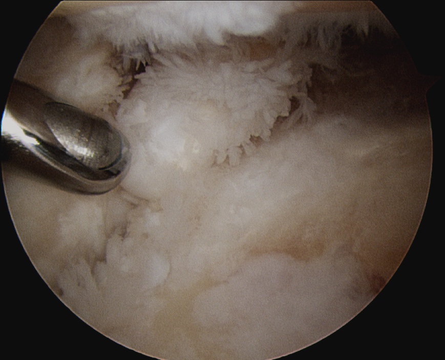 RA arthroscopy shoulder 1