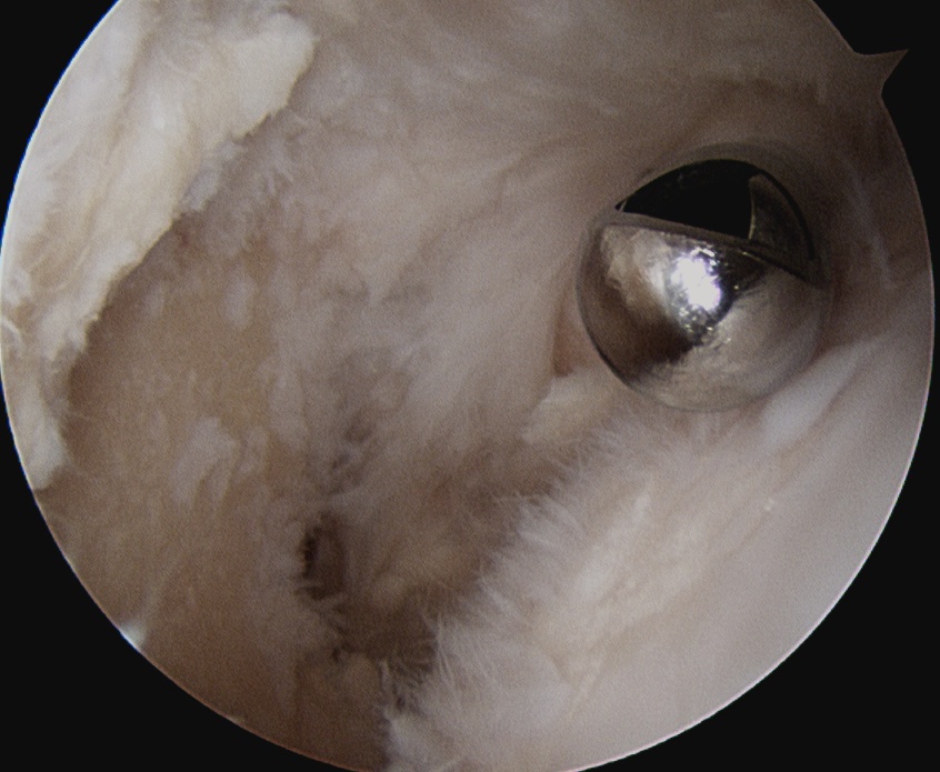 RA shoulder arthroscopy 4