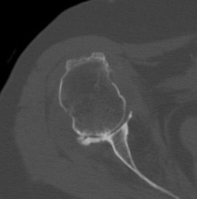 RA shoulder CT