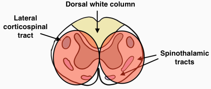 Anterior cord syndrome