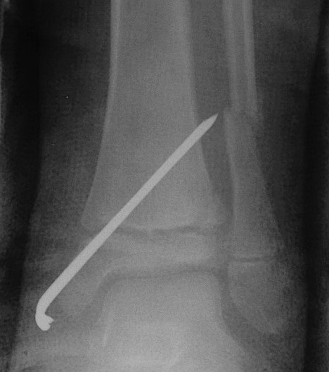 SH2 distal tibia 3