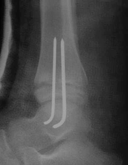 SH2 distal tibia 4