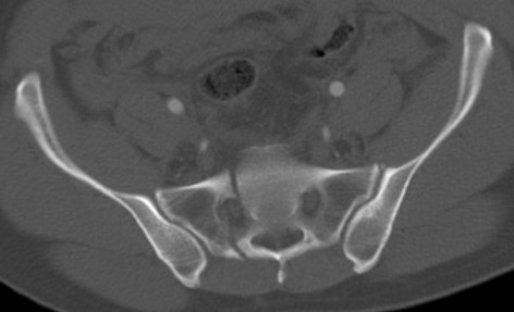 Zone 3 sacral #