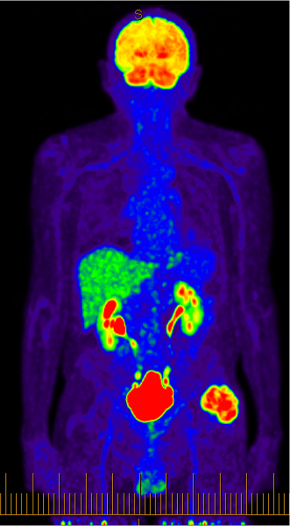 Sarcoma PET