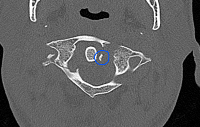 lig avulsion