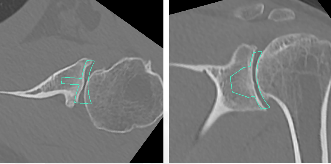 Augmented glenoids