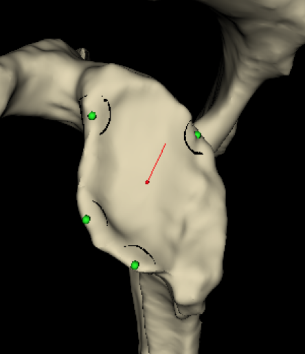 Glenoid template 2