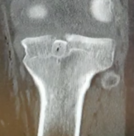 Tibial inlay 1