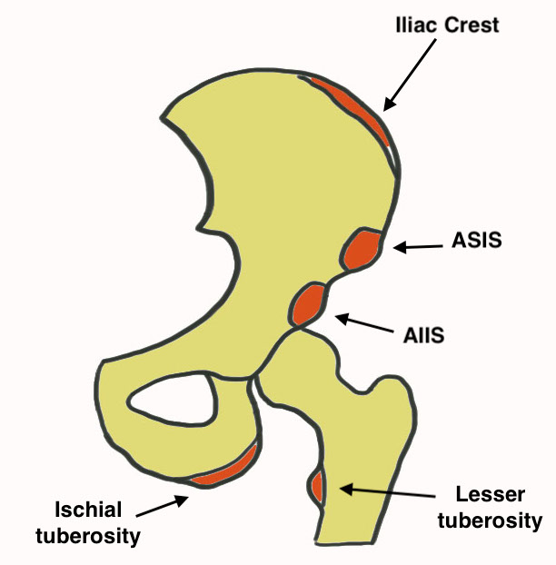 Pelvic apophyseal avulsions