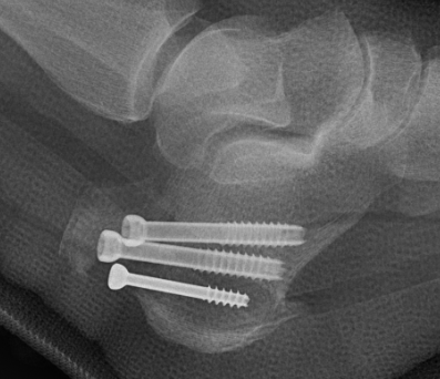 Tuberosity