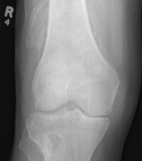 Knee syn osteo xray