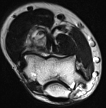 Synovial sarc elbow 1