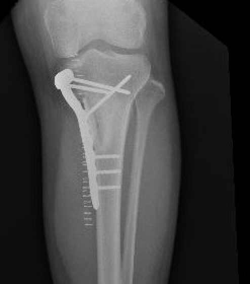 Chondromyxoid fibroma surgery 1