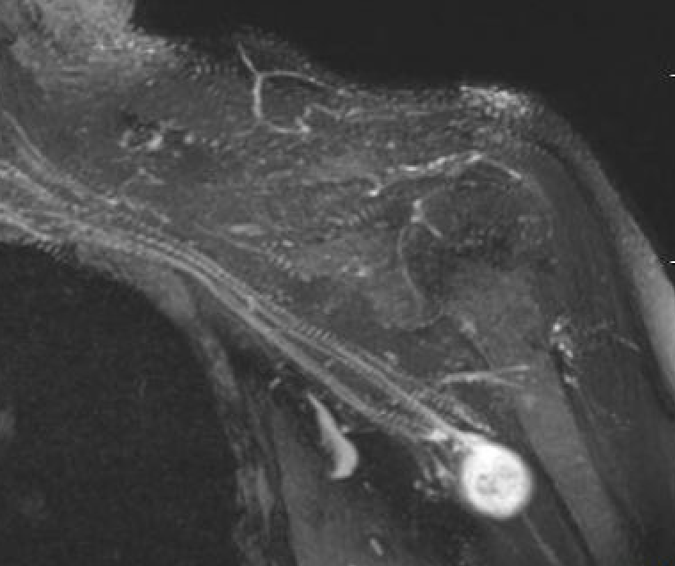 Neurofibroma 1