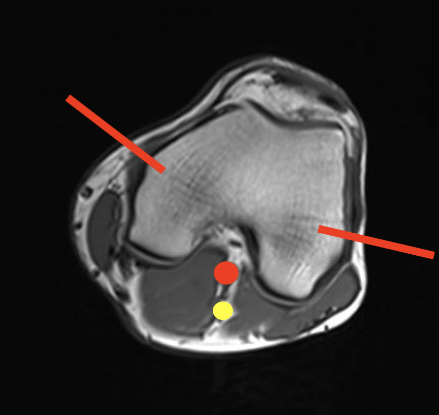 Fem condyle biopsy