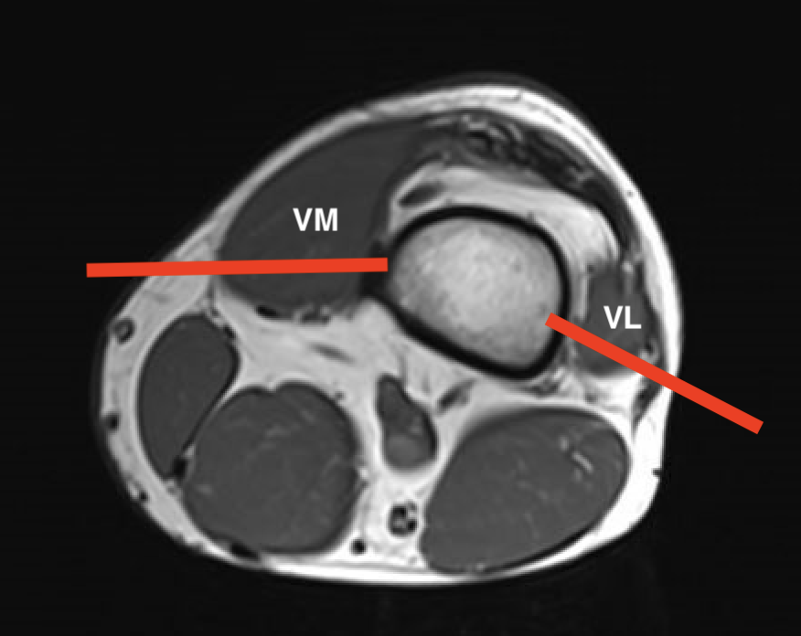 Fem condyle biopsy