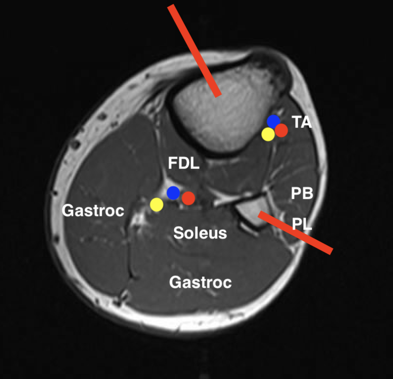 Tibia biopsy 2