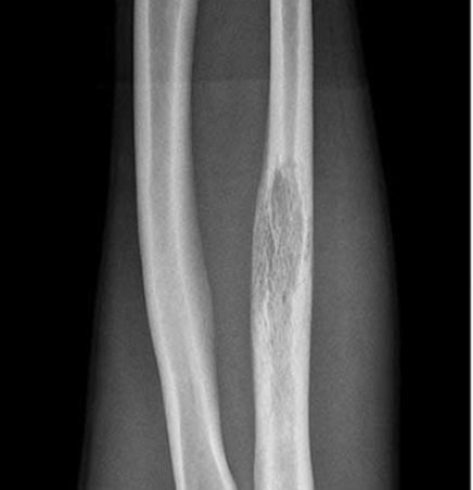 Ulna tumour