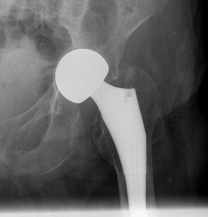 Acetabular erosion