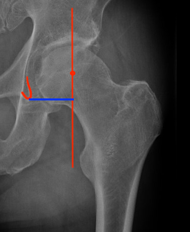 Acetabular offset