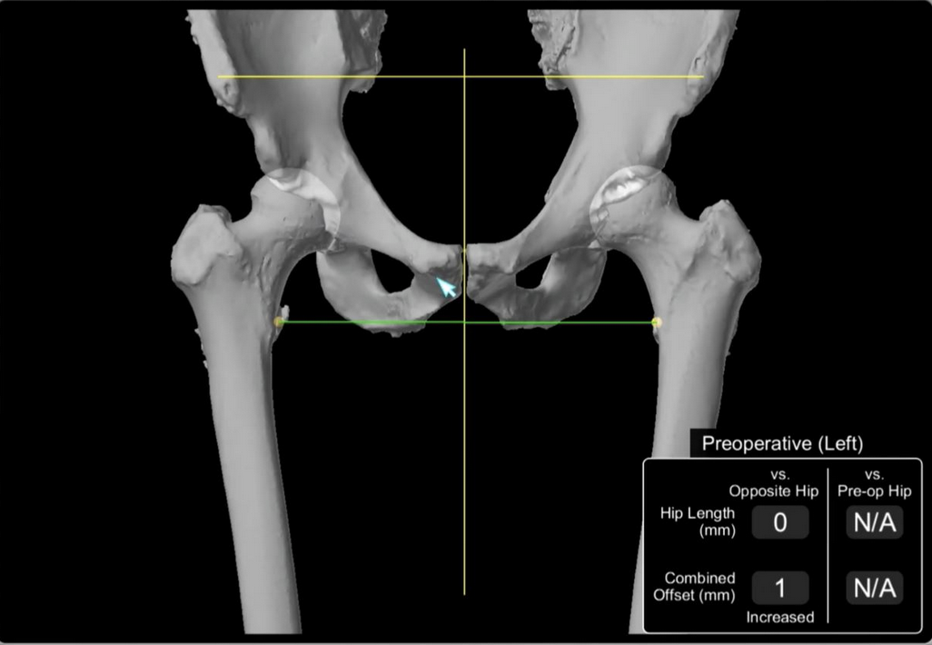 Stryker CT