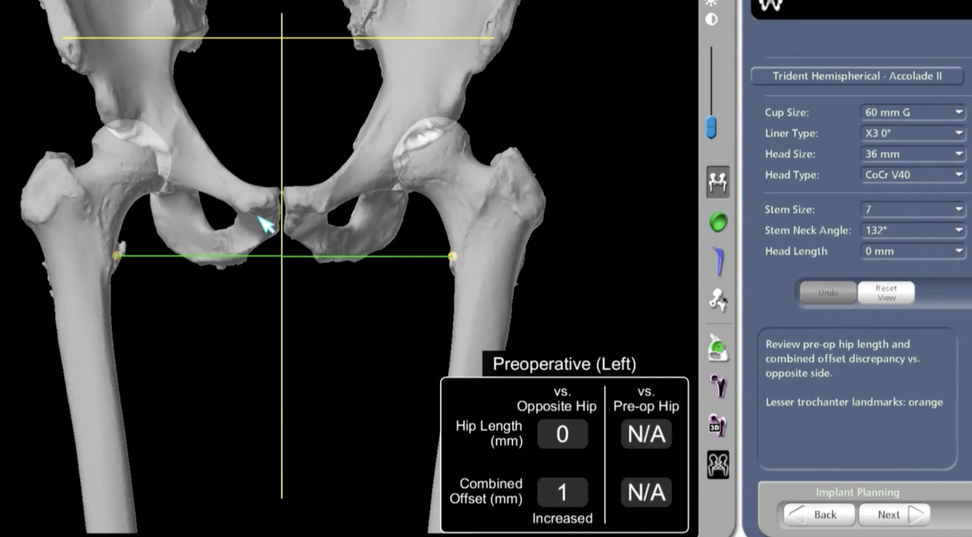 Stryker Mako Hip Navigation