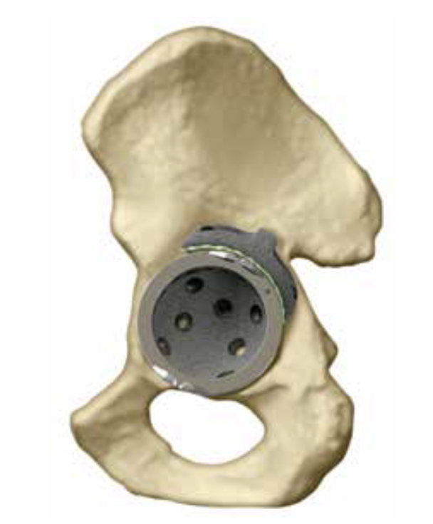 Zimmer trabecular metal