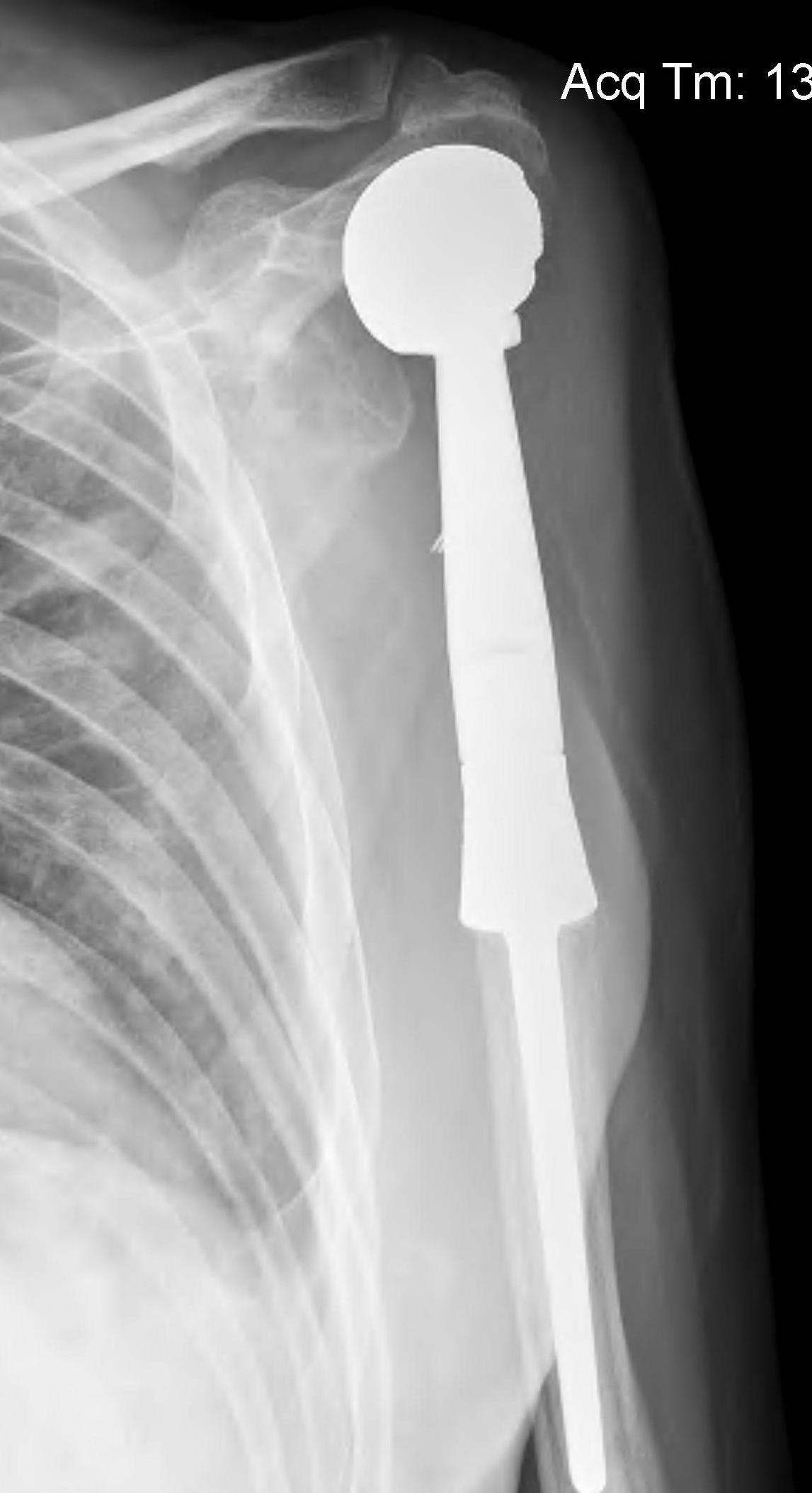 Shoulder tumour prosthesis