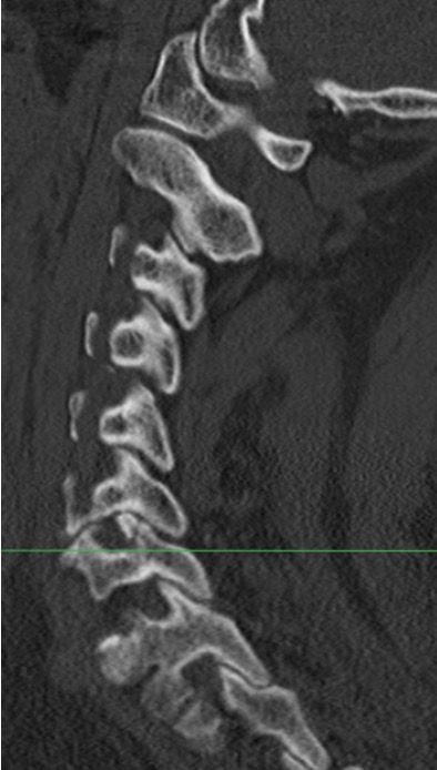 Small superior articular facet fracture