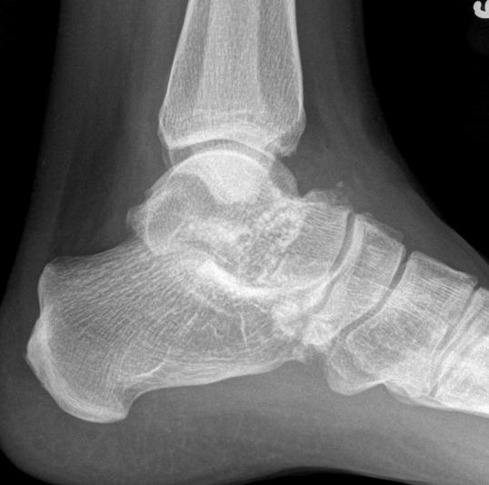 Ankle xray synovial osteochondrondromatosis