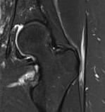 Trochanteric bursitis MRI