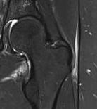 Trochanteric bursitis 2 MRI