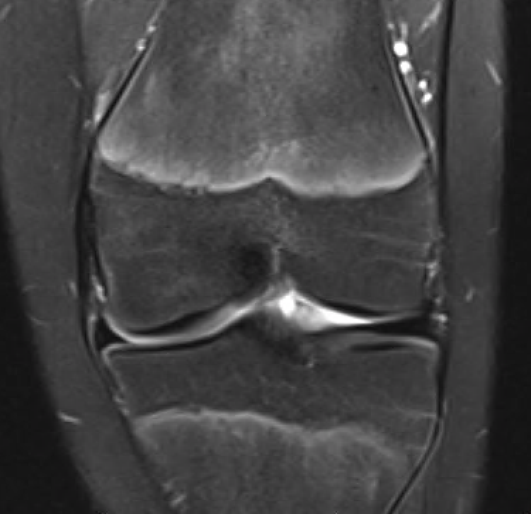 OCD T2 edema post