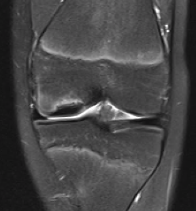 OCD T2 edema pre