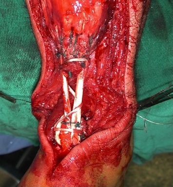 Gracilis transfer