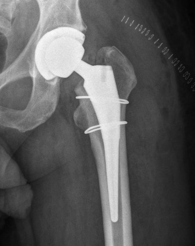 THA intra-op femur