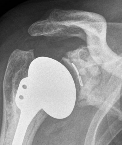 aTSA loose glenoid