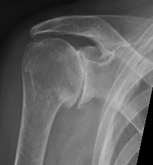 Glenohumeral joint OA Grade 2