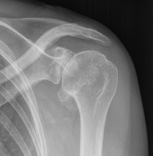 Type 3 Glenohumeral joint OA