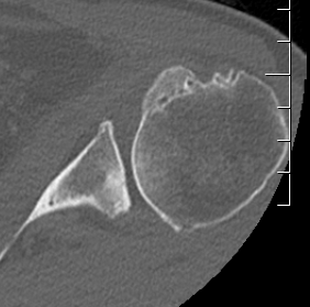 Triangular vault scapula