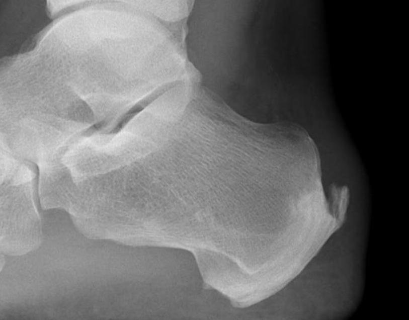 Achilles calcification