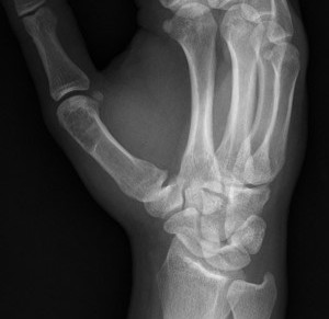 Thumb enchondroma